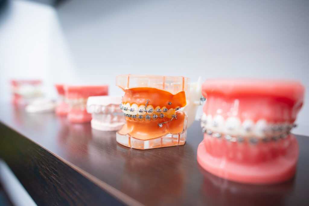 braces types