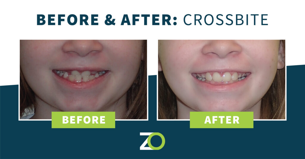 before and after crossbite