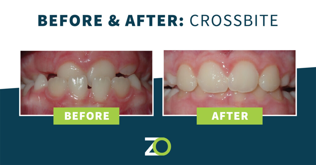 Crossbite before and after