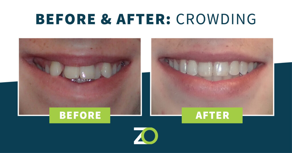 teeth crowding before and after