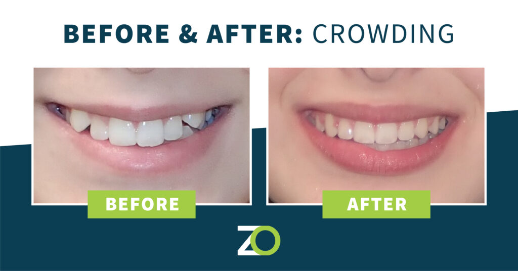 before and after crowded teeth