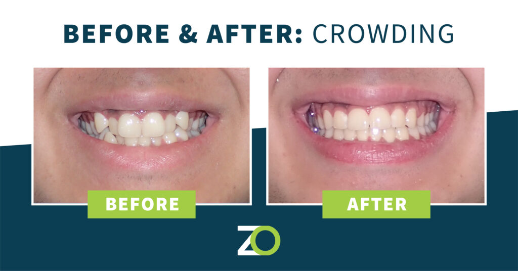 teeth crowding before and after