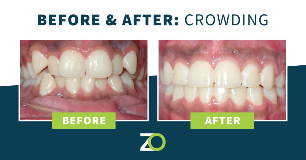 fixing crowded teeth