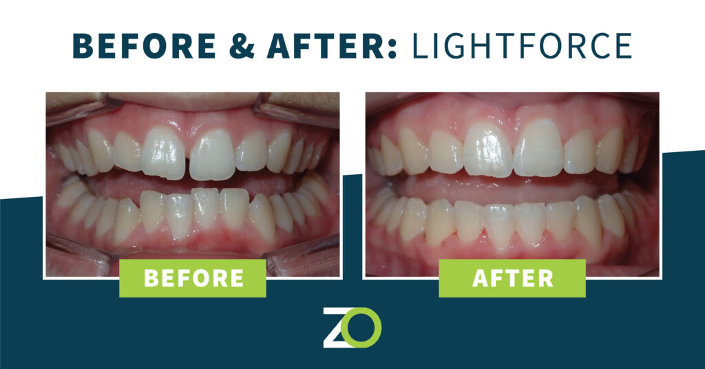 Gap Teeth Before and After with LightForce Braces