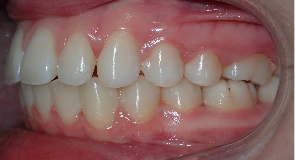 gaps in teeth after braces