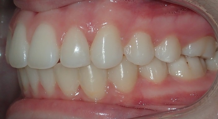 teeth bonding after braces