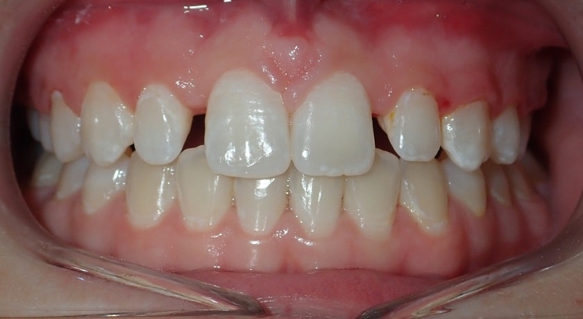 gap in teeth after braces
