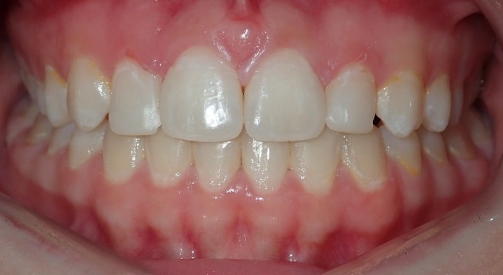 bonding after braces