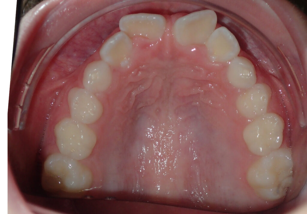 teeth before palate expander