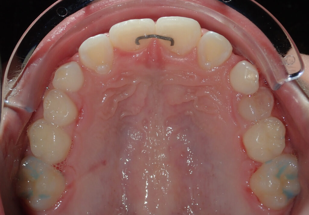 teeth after palate expander