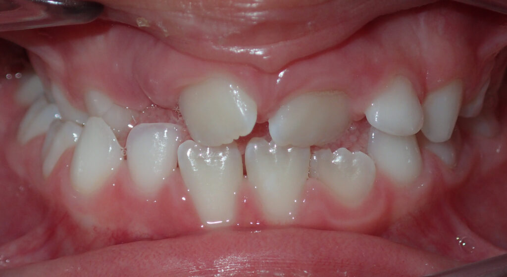 crossbite before expander