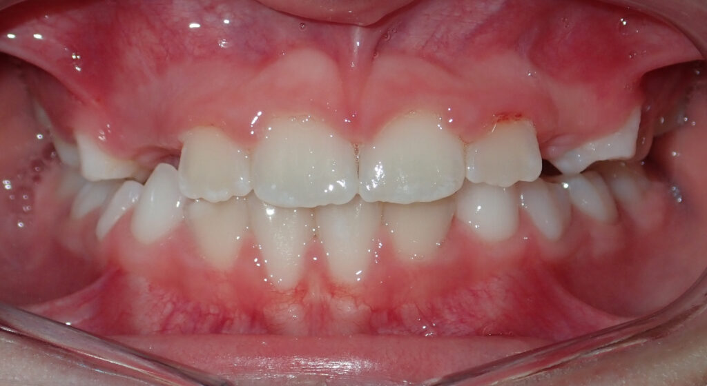 crossbite after palate expander